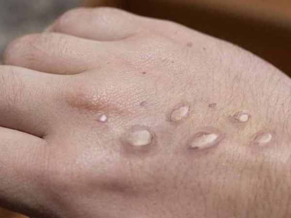 monkeypox-fears-prompt-smart-lockdown-in-jamruds-ghandi-area