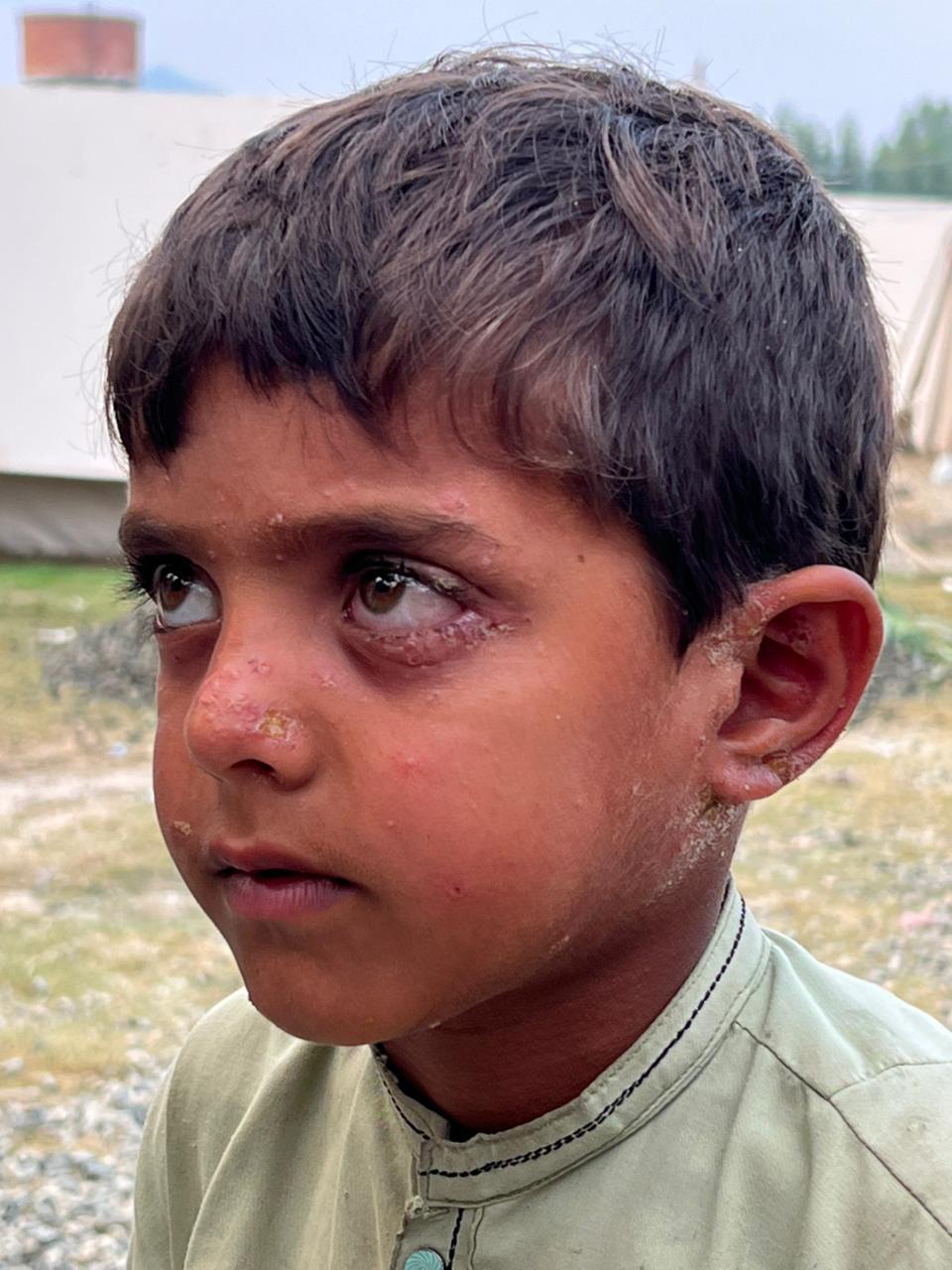skin-diseases-spread-among-children-in-bajaur-idp-camp-amid-poor-hygiene-and-lack-of-medical-care