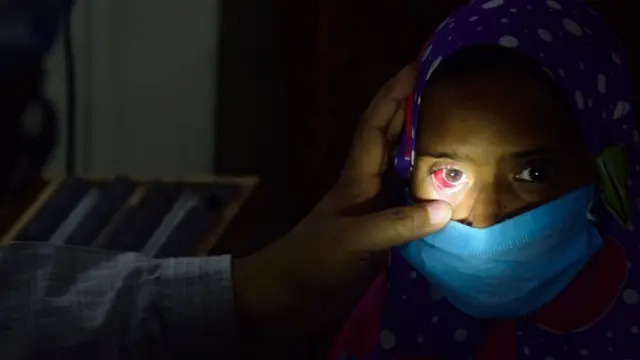 conjunctivitis-outbreak-sweeps-malakand-over-1600-cases-reported-in-batkhela