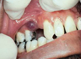 silent-epidemic-late-diagnosis-driving-oral-cancer-deaths-in-pakistan