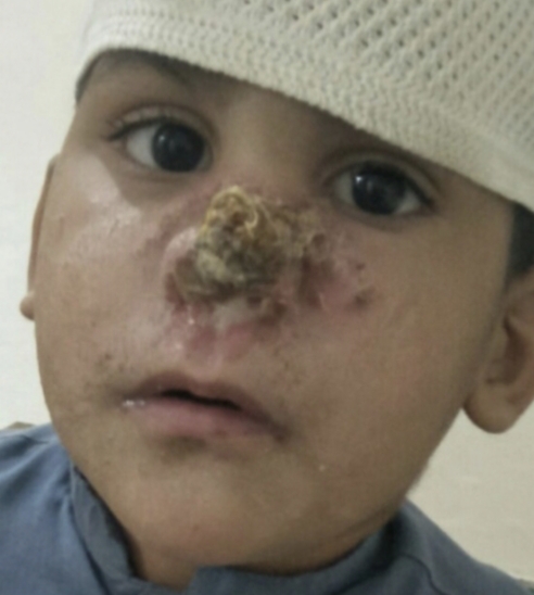 patients-left-waiting-as-leishmaniasis-injections-remain-unavailable-in-landi-kotal