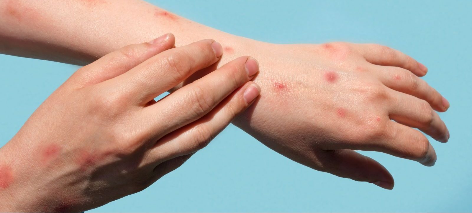monkeypox-cases-rise-in-kp-as-peshawar-reports-highest-infections