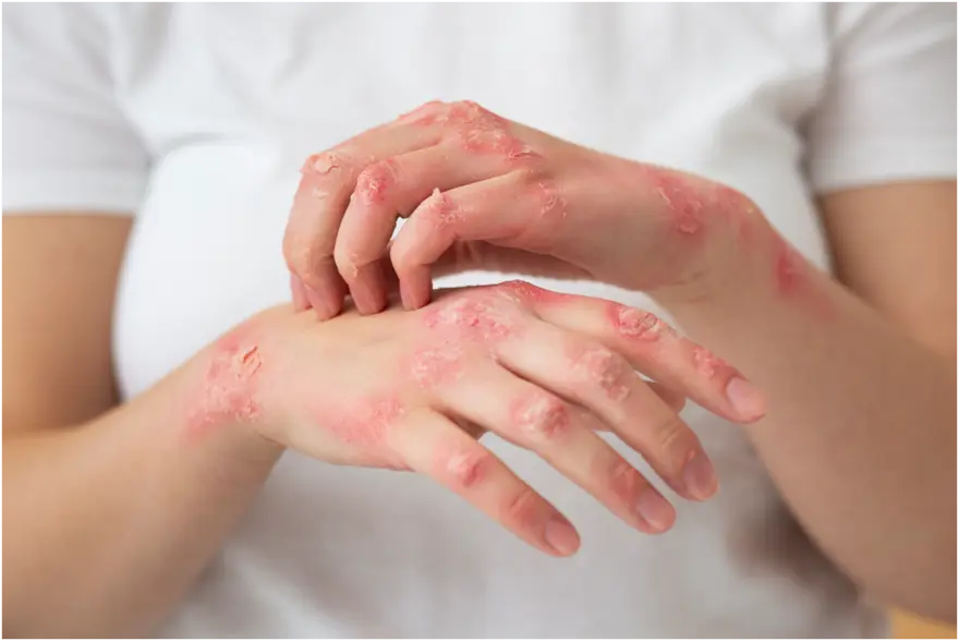 free-medical-camps-for-scabies-patients-to-be-held-across-khyber-district