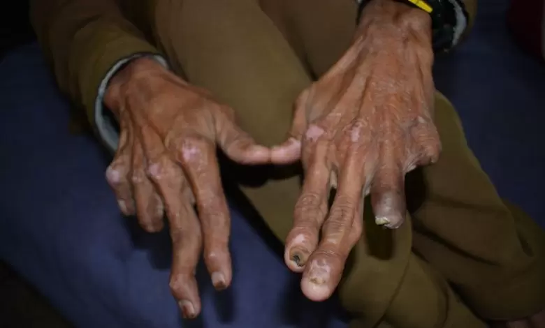 battling-stigma-and-disease-leprosy-treatment-efforts-in-bajaur