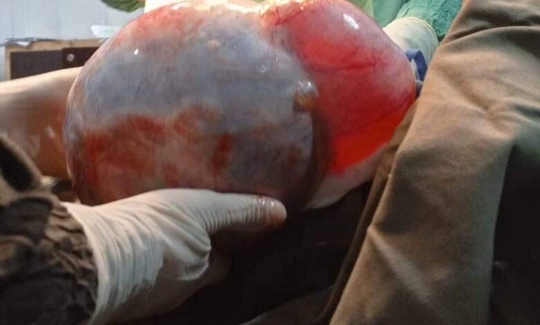 surgical-team-removes-10kg-uterine-tumor-in-bajaur-district